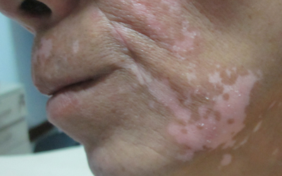  怎么快速治療青少年的白癜風比較好