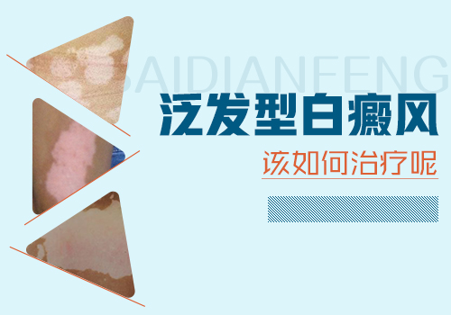 白癜風已經病發全身了怎么治療