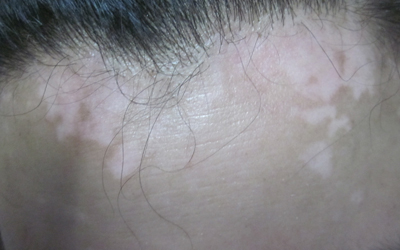 頭上有白癜風去醫院會怎么治療