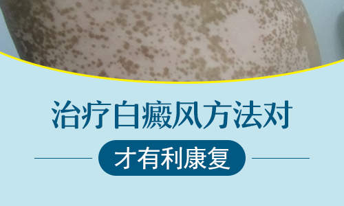穴位埋線是治白癜風新技術嗎效果怎么樣