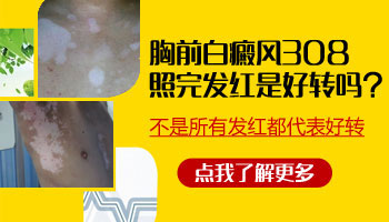 308激光照白癜風(fēng)部位都會(huì)發(fā)紅嗎