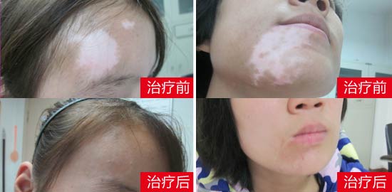 臉上白斑照308激光恢復圖片