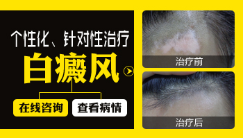 有沒有眼皮白癜風康復的案例