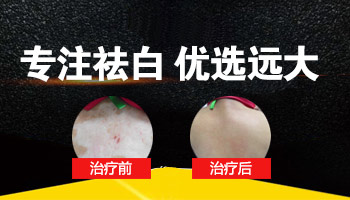 白癜風種植黑色素多久能恢復