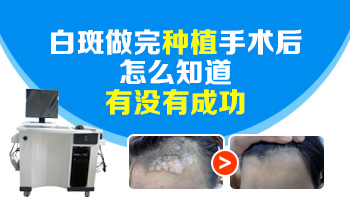 植皮治療白癜風一平方厘米大概多少錢