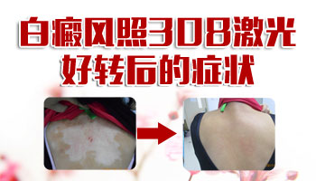 308激光能治療好白斑嗎治好花多少錢