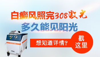 308激光照一次白癜風大概花多少錢