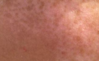 怎么醫治男性面部白癜風