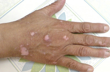 手上的白斑復發了怎么辦