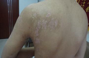 為什么白癜風治療后仍然不見好轉