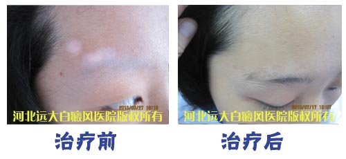 外傷導致的白癜風還會遺傳嗎