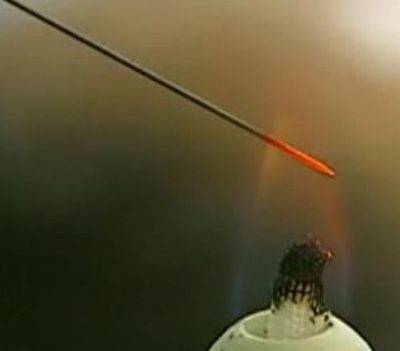 手腳白癜風扎火針