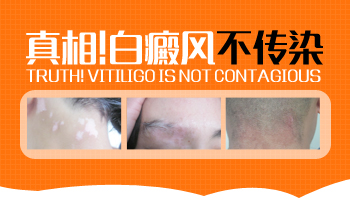 接觸有白癜風(fēng)的人有什么傷害嗎會(huì)傳染我嗎