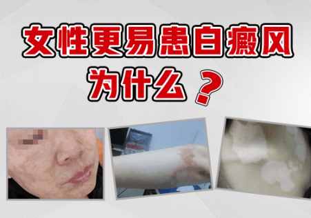 7個(gè)月孩子脖子硬幣大白斑伍德燈檢查為陽(yáng)性是白癜風(fēng)嗎