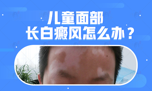 1歲孩子面部圓形白塊不吃藥能治療好嗎,用什么儀器