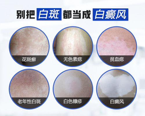 嬰幼兒胸部有一小塊白塊哪種偏方效果好