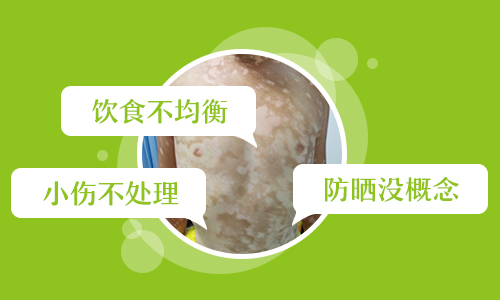 腹部白斑有雞蛋大照308激光一個療程費用,幾個療程能好