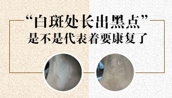 白癜風處在發展期用黑色素移植治療成活率有多高