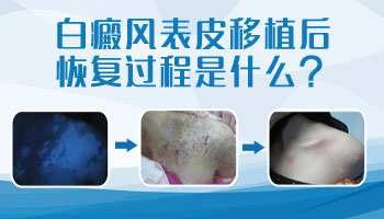 兒童脖頸有白點擦他克莫司能治好嗎