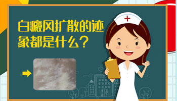 頭部有白斑照308多少錢,長期照射好嗎