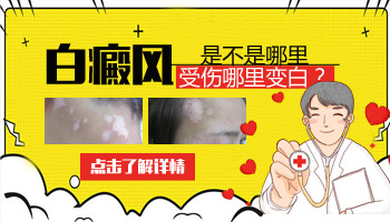 腹部白癜風(fēng)有拳頭大照進(jìn)口308激光一次多少錢