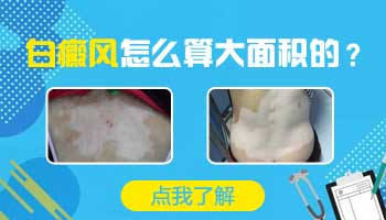 兒童胸部有白塊照uvb一次要多少錢