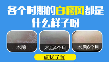 7個月孩子脖子圓形白斑用伍德燈能檢查出來嗎