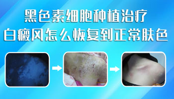 7個月孩子脖子有白斑一直發展用什么方法控制