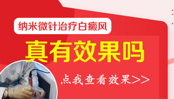 1歲孩子面部圓形白斑照美國308激光效果好不好