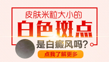 脖子白斑有雞蛋大用308nm準分子激光照多少錢