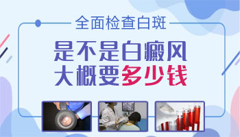 胸部白癜風(fēng)有拳頭大照進(jìn)口308激光一次多少錢