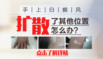 7個月孩子腰部有白點用311紫外線好還會308激光好