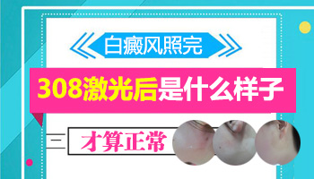 胸部白癜風(fēng)有拳頭大照一次308激光大概多少錢