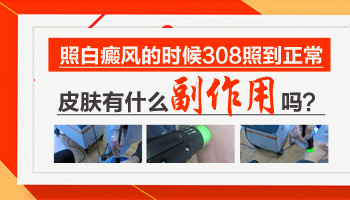 胸部白癜風(fēng)有拳頭大照308激光一周幾次 一次多少錢
