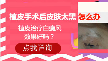 7個月孩子胸部有一小塊白塊wood燈下皮膚為灰白色像白癜風嗎