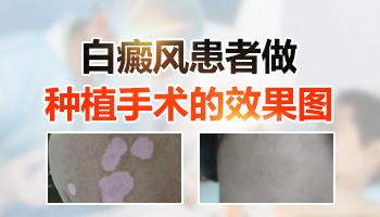 腋下長有一片白斑照308激光一個療程費用,幾個療程能好