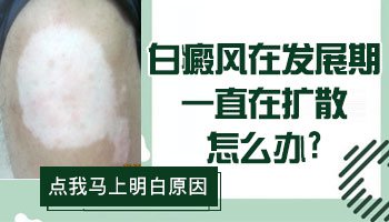 腹部白癜風(fēng)有拳頭大照進(jìn)口308激光一次多少錢