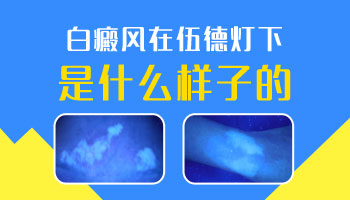 脖子有白癜風照308激光一個療程多少錢