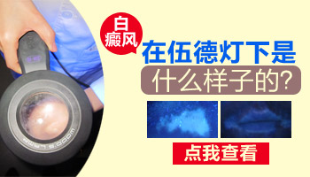 額頭有發展期白癜風照308激光好不好,一次多少錢