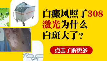 白癜風處在發展期用黑色素移植治療成活率有多高