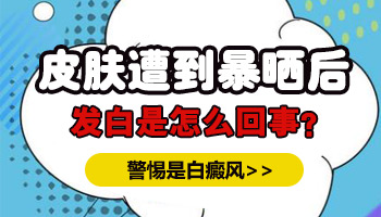 面部白癜風有拳頭大照308激光一次多少錢