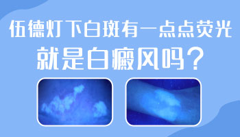 額頭長早期白癜風照308激光一周幾次 一次多少錢