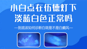 胸部白癜風(fēng)有拳頭大照308激光好不好，一次多少錢