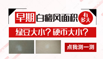 1歲孩子腳上有白斑怎么診斷是不是白癜風