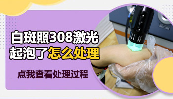 腋下長早期白癜風照一次308激光大概多少錢