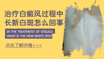 面部白癜風有拳頭大照308激光好不好，一次多少錢