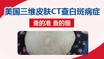 如何辨別白癜風(fēng)